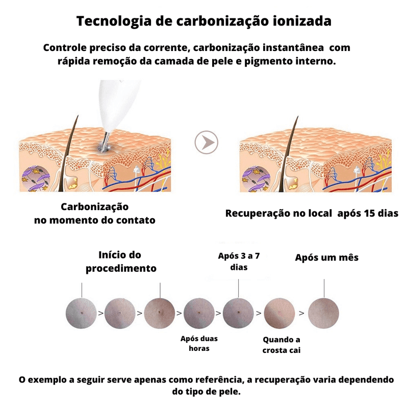 Caneta Jato de Plasma Removedora de Manchas Verrugas Acnes Sinais e Pontos Pretos