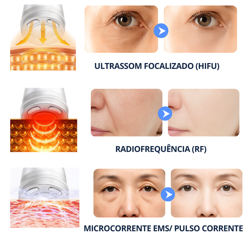 Mini Hifu Lifting Facial