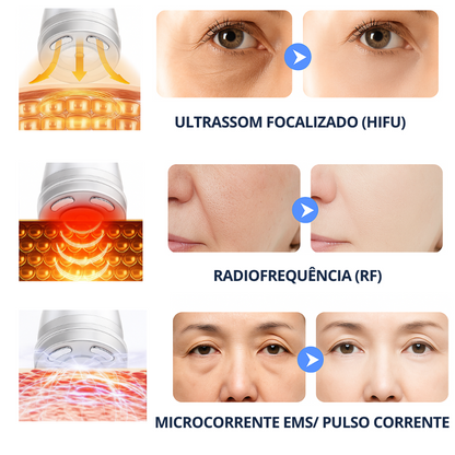 Mini Hifu Lifting Facial