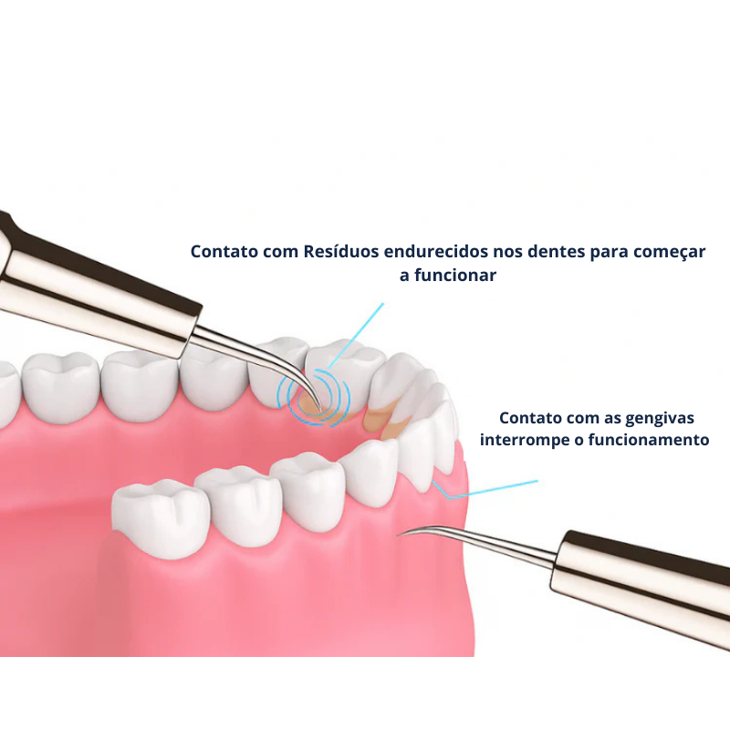Removedor de Tártaro Dental Ultrassônico Delopar - 9 Velocidades
