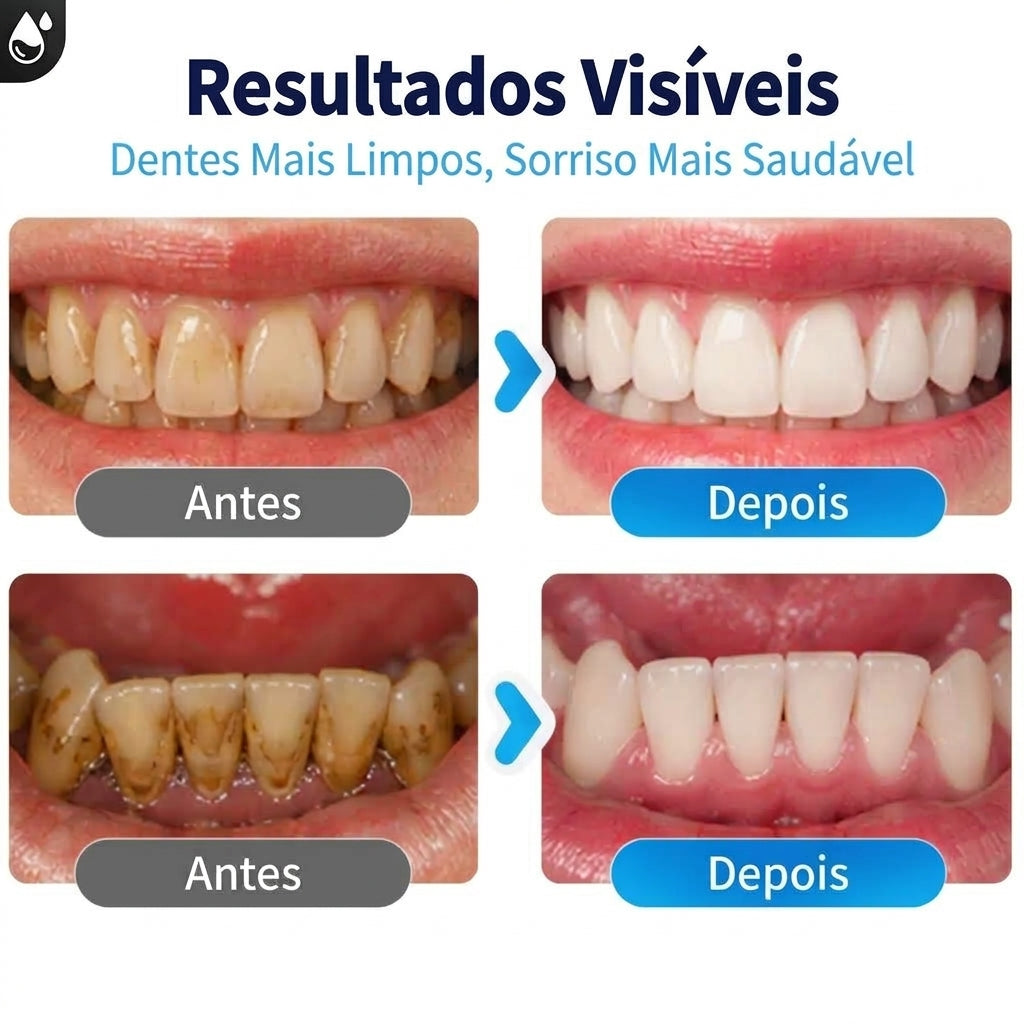 Removedor de Tártaro Dental Ultrassônico Delopar - 9 Velocidades