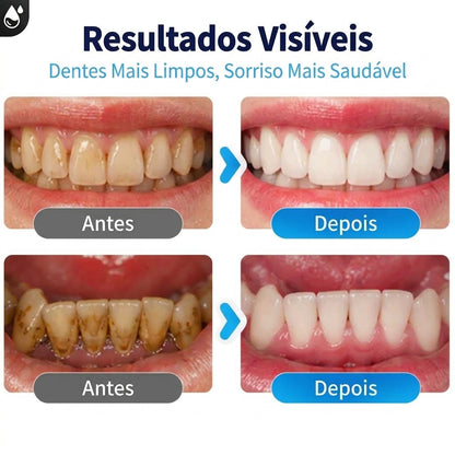 Removedor de Tártaro Dental Ultrassônico Delopar - 9 Velocidades